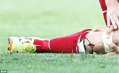 Chấn thương kinh hoàng của Diego Costa. Ảnh: AP Chấn thương kinh hoàng của Diego Costa. Ảnh: AP
