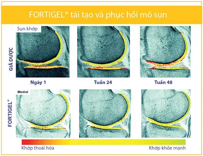 Collagen Fortigel tối ưu tái tạo sụn khớp