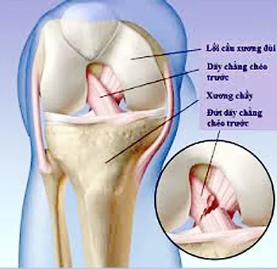 Đứt dây chằng chéo trước: Khi nào cần phẫu thuật?