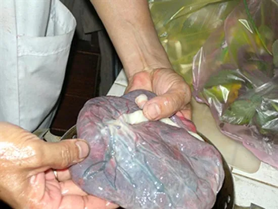 Hiểm họa thuốc nhau thai người