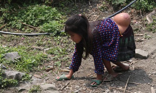 Girl La Thi Lua with giant tumor on the body (Photo: SGGP) Girl La Thi Lua with giant tumor on the body (Photo: SGGP)