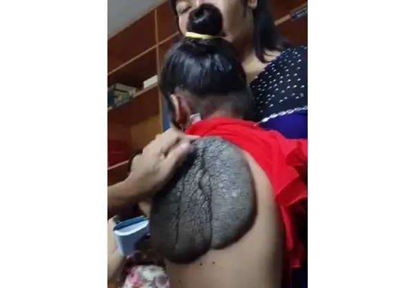 Phẫu thuật thành công cho cô bé "mai rùa"