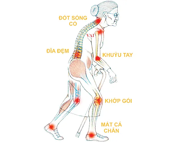 Đau xương khớp: Không rút độc, vĩnh viễn không khỏi