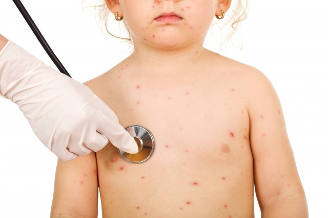 Initial symptoms include sudden onset of slight fever and feeling tired and weak and later followed by an itchy blister-like rash. Initial symptoms include sudden onset of slight fever and feeling tired and weak and later followed by an itchy blister-like rash.