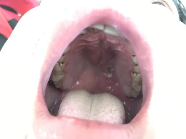 Gắp thành công viên đạn bi từ vòm họng
