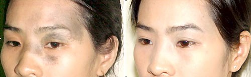 Laser Technology with Cosmetic Surgery in Viet Nam ảnh 1 Laser Technology with Cosmetic Surgery in Viet Nam ảnh 1