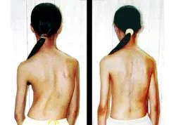 3 cấp độ vẹo cột sống