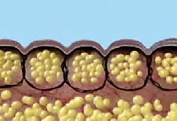 Cellulite và thẩm mỹ da