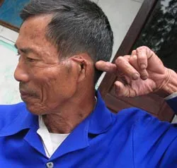 Bài 1: Vết sẹo thành rãnh trên thái dương ảnh 2 Bài 1: Vết sẹo thành rãnh trên thái dương ảnh 2