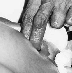 Bài 2: Phẫu thuật không dao mổ!