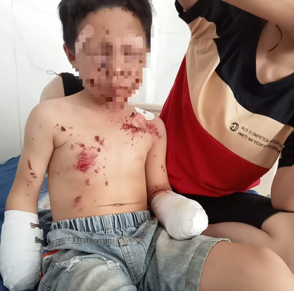 Ngoài bị mất 2 bàn tay, cháu C. bị đa chấn thương vùng mặt, bụng và chân