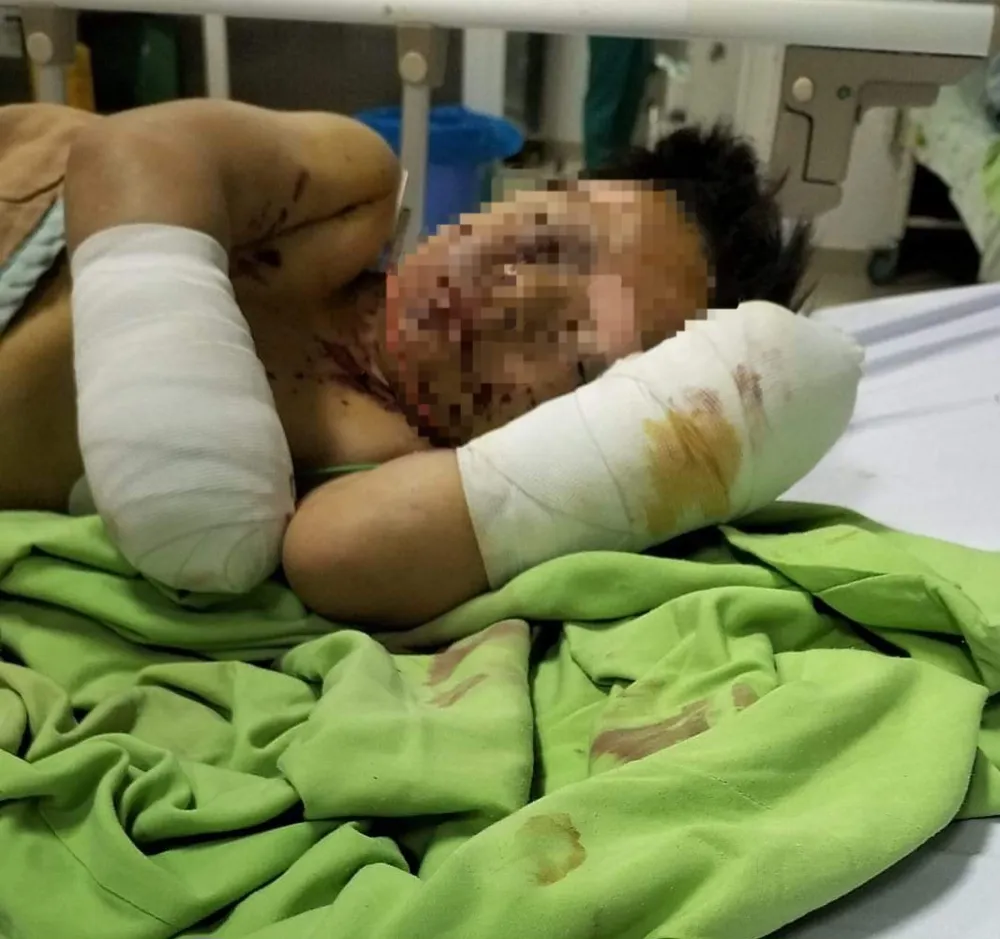 Cháu C. bị mất 2 bàn tay sau vụ nổ