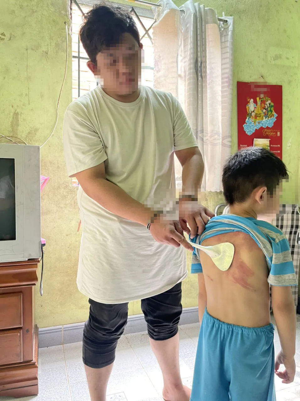 Cháu Đ. bị thâm tím toàn thân vì bị cha ruột đánh Cháu Đ. bị thâm tím toàn thân vì bị cha ruột đánh