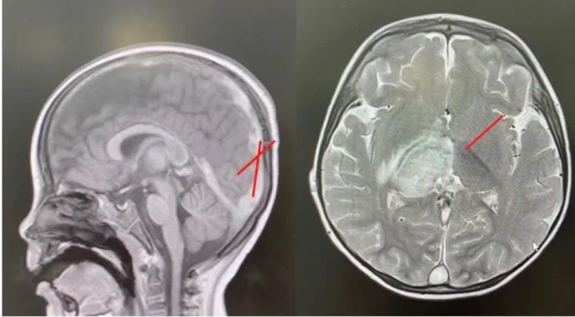 រូបភាព MRI នៃដុំឈាមខួរក្បាល និងដំបៅក្នុងកុមារ 506876350_942567154585017_4700702711508232441_n.jpg