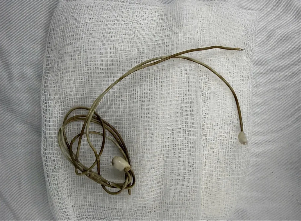 חוט טלפון תקוע בשלפוחית השתן של המטופל 594965548_1512353343636887_6775235640008306410_n.jpg