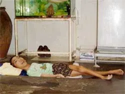 Trẻ em bị bệnh teo cơ Delta của huyện Nghi Xuân, Hà Tĩnh được hỗ trợ phẫu thuật