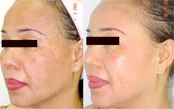 Điều trị nám Melasma