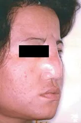 Tai biến từ phẫu thuật thẩm mỹ - vì sao?
