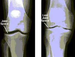 Điều chế Glucosamine để tránh ô nhiễm môi trường