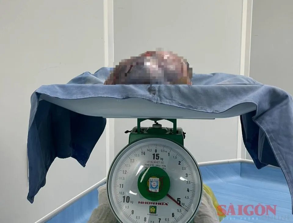 Đây là khối u lớn nhất từ trước đến nay do Bệnh viện đa khoa khu vực Quảng Nam thực hiện phẫu thuật bóc tách