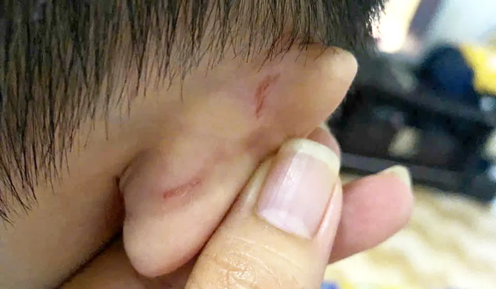 Gia đình chị Thái Thị Thu Th. cung cấp hình ảnh về sự việc con mình xuất hiện các vết xước, bầm z7163396450068_537989ce3fc185ea9b01db0d764d17e1.jpg