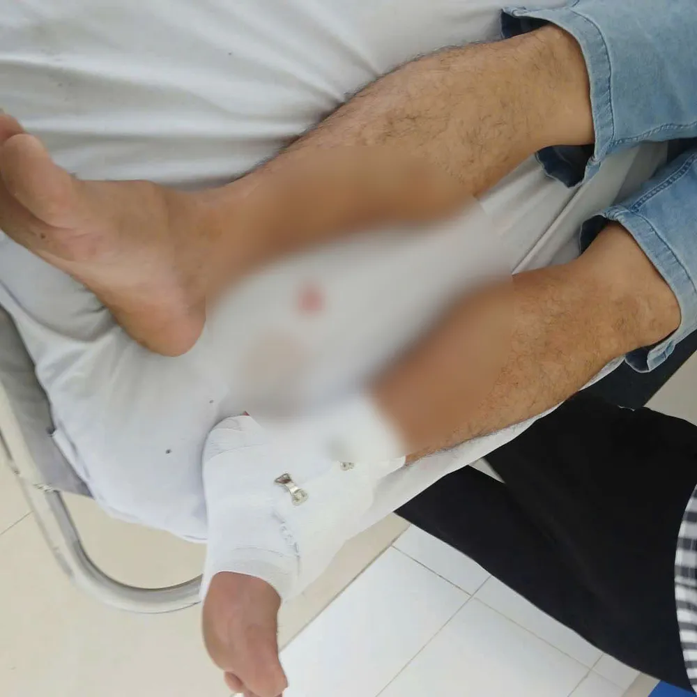 Ông P.T.T. bị cá sấu cắn trúng chân 1000015758-3875-8230-1609.JPG