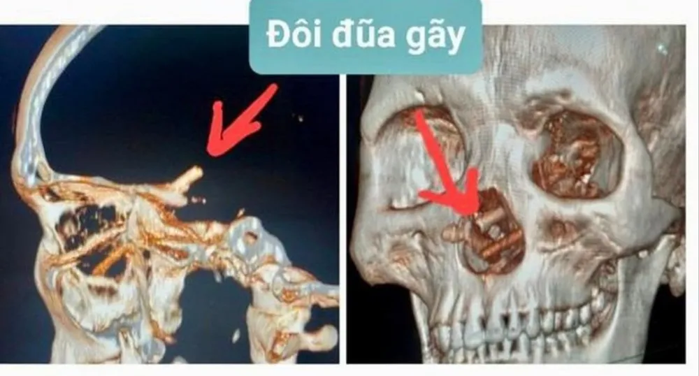 Chụp CT Scanner sọ não anh T phát hiện đôi đũa gãy Chụp CT Scanner sọ não anh T phát hiện đôi đũa gãy