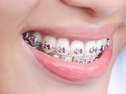 矯正牙齒前要了解事項