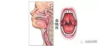 兒童扁桃體術後要如何護理?