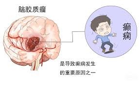 正常人突發癲癇或是腦膠質瘤作祟