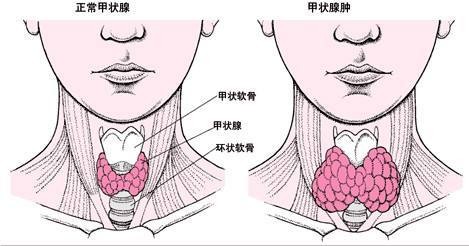 甲亢病人愛在夏天紮堆