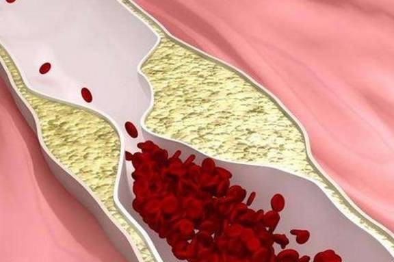 血液黏稠，早起可能会有这３个表现