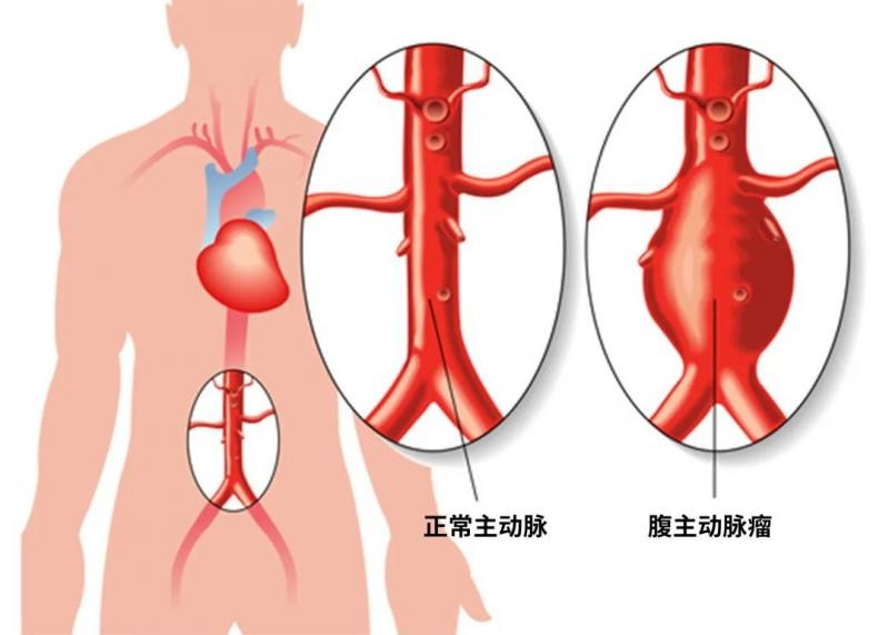 这种瘤不易发现但却十分凶险