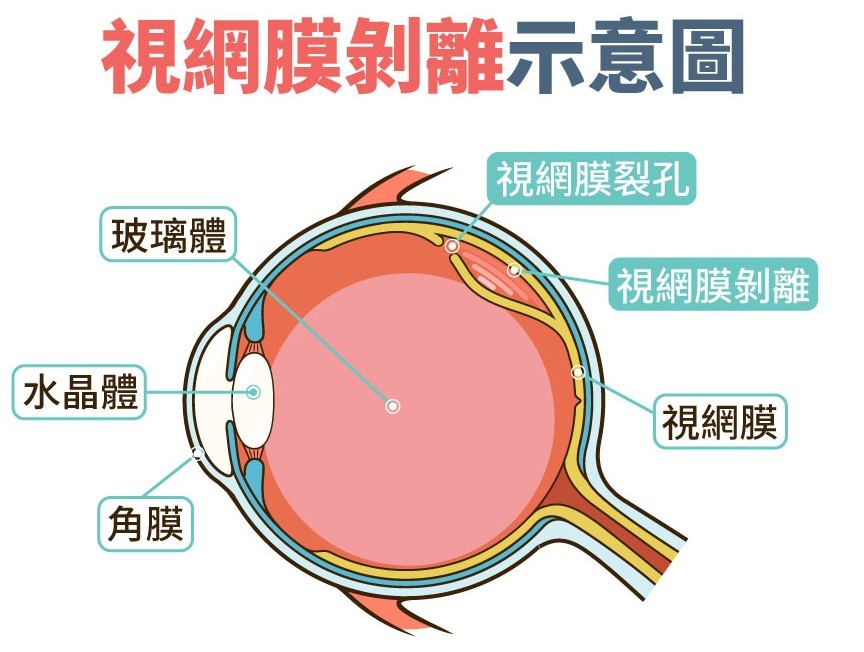 小心视网膜剥离会失明！