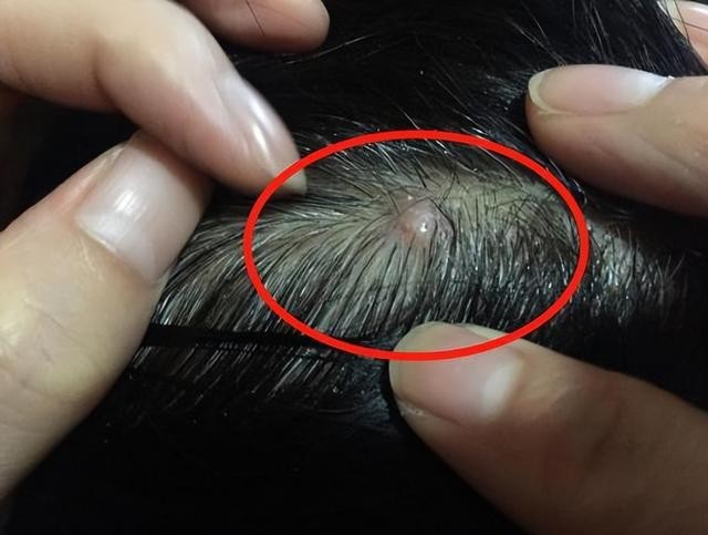 头皮总是长疙瘩和脓包! 或是“4种疾病”信号