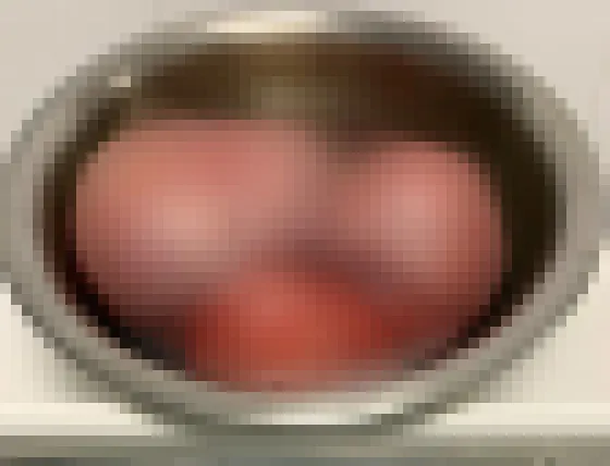 Phẫu thuật thành công khối u xơ tử cung nặng 5,5kg ảnh 1