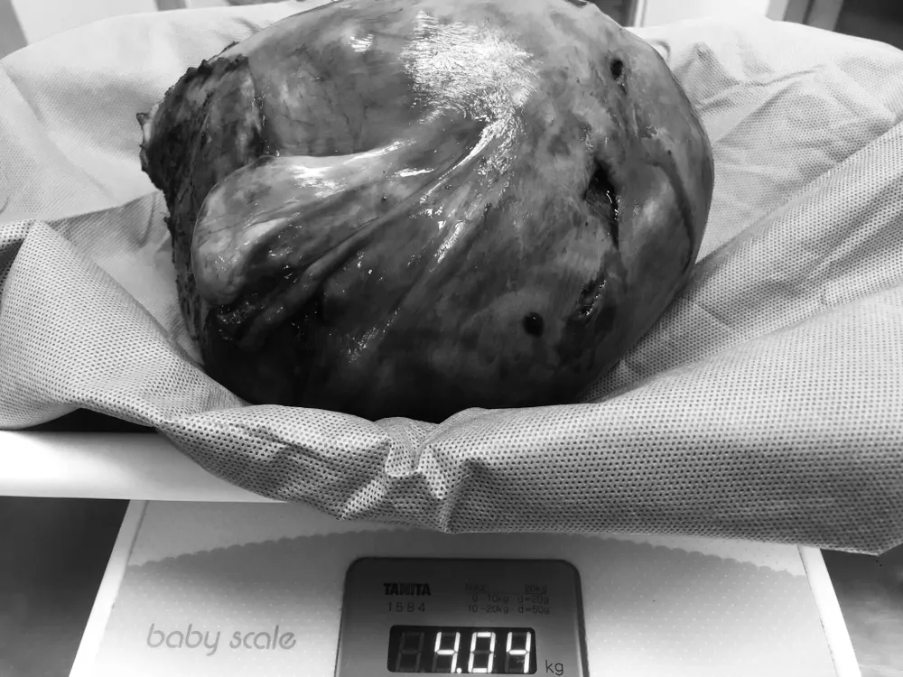 Phẫu thuật thành công khối u xơ tử cung nặng hơn 4kg ảnh 1 Phẫu thuật thành công khối u xơ tử cung nặng hơn 4kg ảnh 1