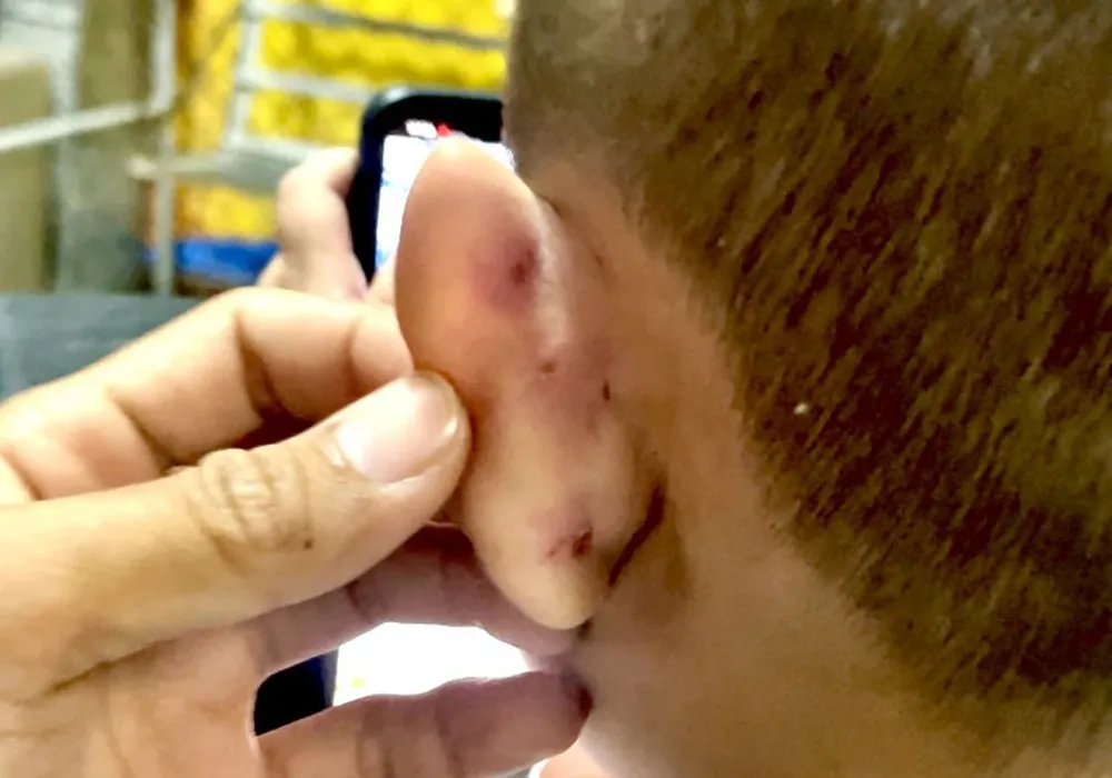Bé M. với vành tai bị thương do cô giáo đánh. Ảnh: CTV Bé M. với vành tai bị thương do cô giáo đánh. Ảnh: CTV