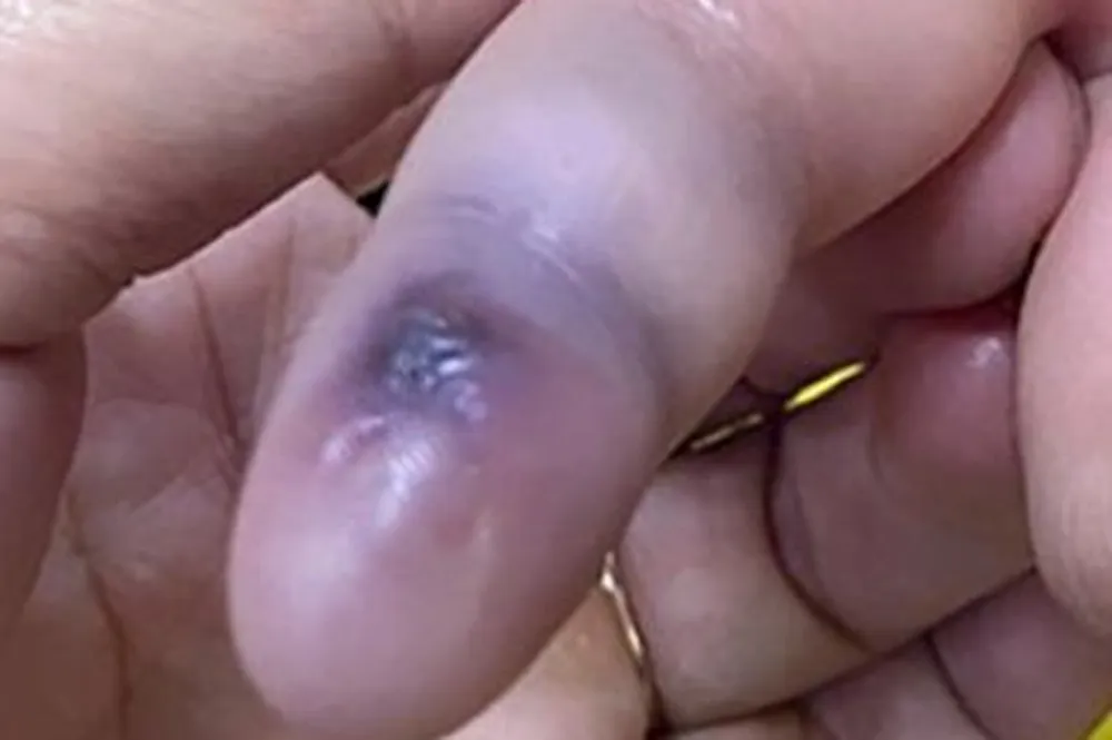 Ông L. bị rắn lục đuôi đỏ cắn ở tay trong lúc làm việc. Ảnh: CTV Ông L. bị rắn lục đuôi đỏ cắn ở tay trong lúc làm việc. Ảnh: CTV