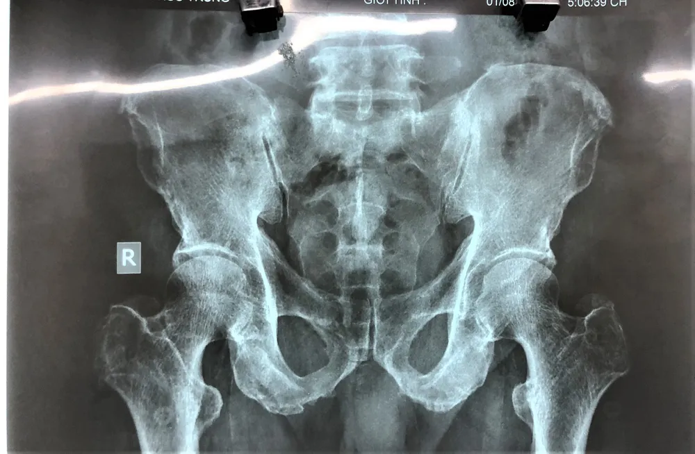 Sử dụng dị vật, cụ ông phải mổ cấp cứu ảnh 2