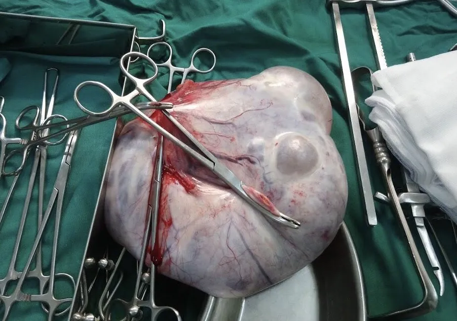 Phẩu thuật thành công lấy được khối u buồng trứng nặng 6 kg ảnh 2