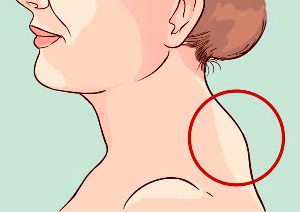 长时间保持不良姿势容易形成“富贵包”。