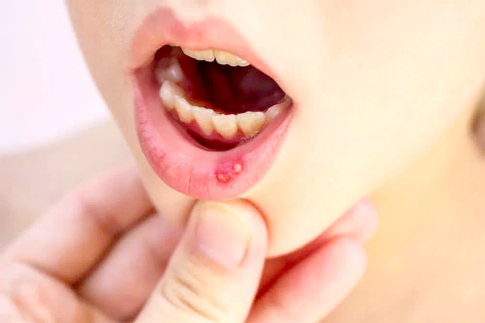 如何缓解口腔溃疡？