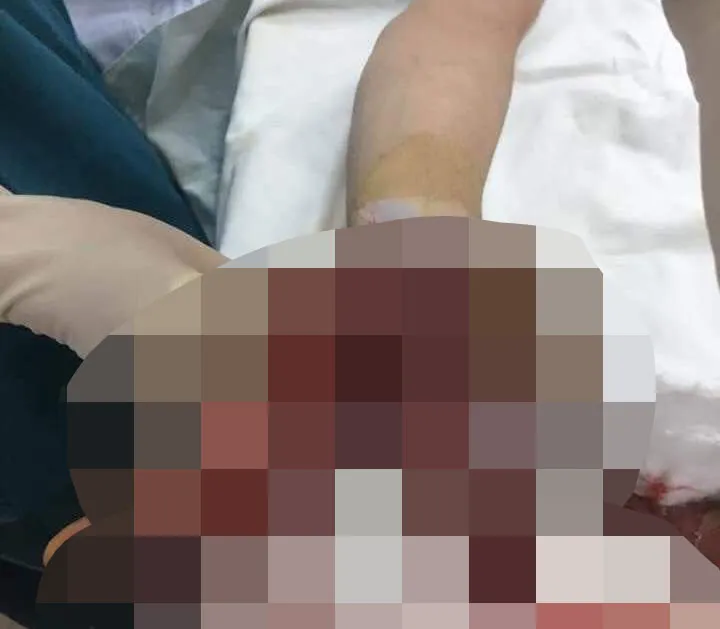 Bàn tay của V. bị dập nát khi điện thoại phát nổ khi vừa sạc, vừa sử dụng