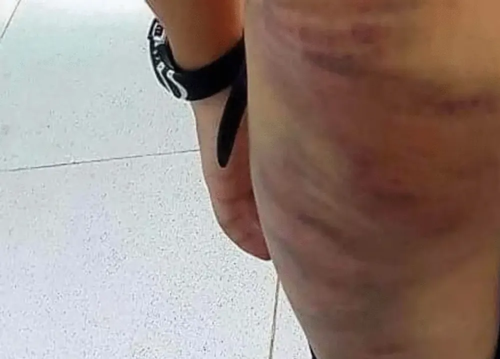 Nhiều vết bầm tím trên cơ thể em L.M.T.