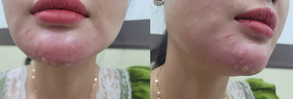 Ảnh 1. Biến chứng nhiễm trùng do tiêm filler không rõ nguồn gốc.jpg