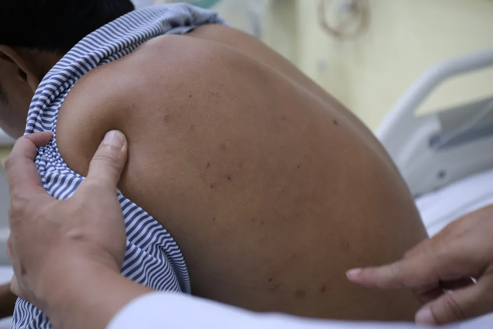 Vết ong đốt trên người bệnh nhân.JPG