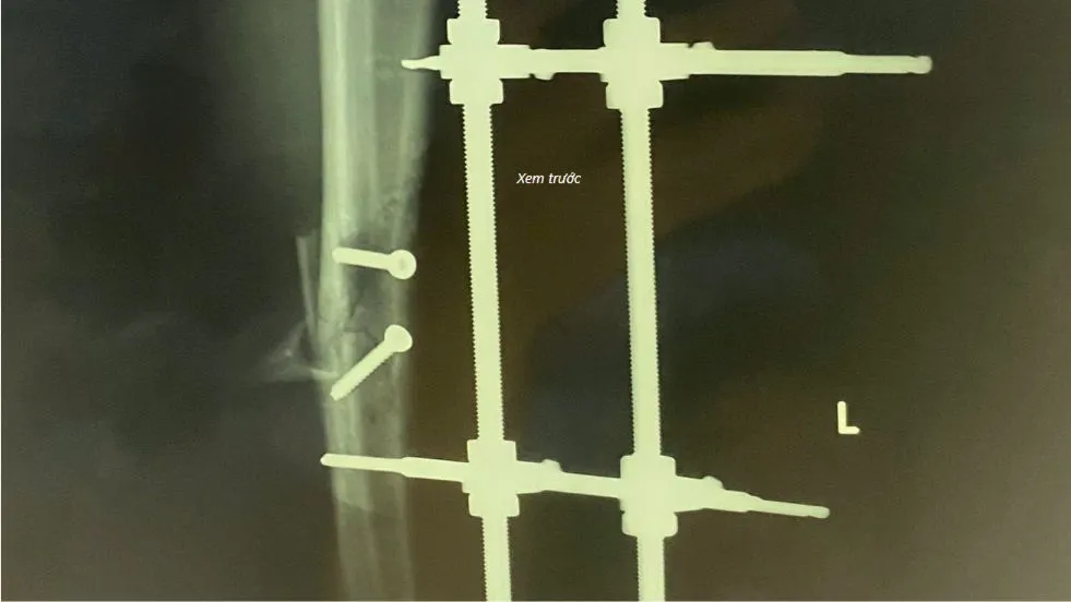 Phẫu thuật thành công cho bệnh nhi bị tai nạn giao thông