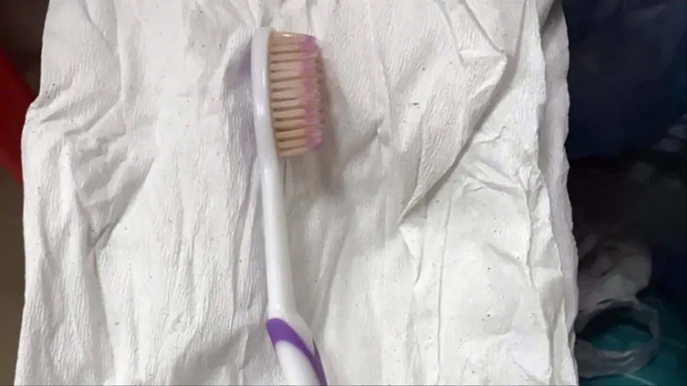 Chiếc bàn chải đánh răng nằm trong thực quản của bệnh nhân được các bác sĩ nội soi lấy ra ngoài. Ảnh: BVĐKĐN