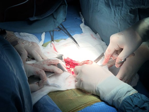 Renal transplant on kid from brain-dead donor for first time